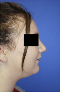 Female Profile After Rhinoplasty Surgery