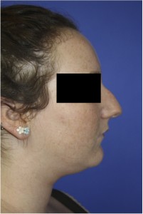 Female Profile Before Rhinoplasty with Nose Bump