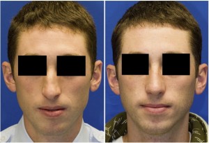 Facial Fracture Before and After Surgery on Male