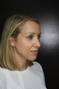 After Rhinoplasty Female Photo Profile