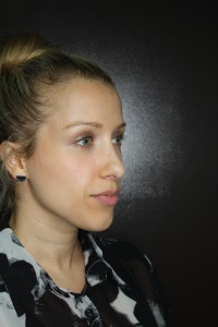 Before Rhinoplasty Photo Profile View