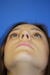 View After Base Rhinoplasty Surgery