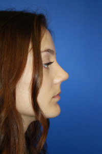 Photo After Base Rhinoplasty Surgery