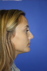 Photo Before Base Rhinoplasty Surgery