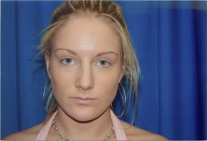 Front View Before Rhinoplasty Surgery to Remove Bump in Nose, Left Side
