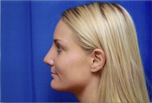 After Rhinoplasty Surgery to Remove Bump in Nose, Left Side