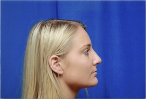 After Rhinoplasty Surgery to Remove Bump in Nose