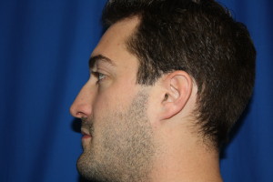 Male Rhinoplasty Before Photo, Left Side