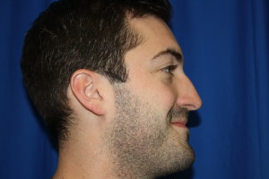 Male Rhinoplasty Before Photo, Right Side