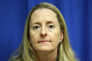 Rhinoplasty Surgery Front Before Photo, Fix Top Nose Bump