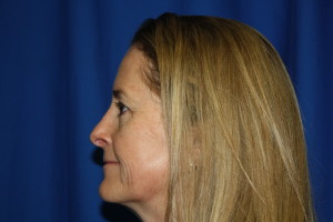 Rhinoplasty Surgery After Photo, Fix Top Nose Bump