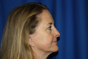 Rhinoplasty Surgery After Photo, Fix Nose Bump