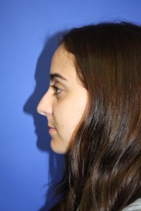 Female, Profile View Before Rhinoplasty Surgery Photo