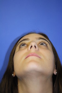 Looking Up View Before Rhinoplasty Surgery