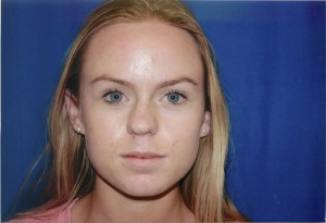 Before Rhinoplasty Surgery, Front Female View