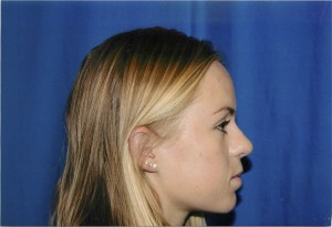 Profile View After Rhinoplasty Surgery