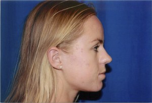 9 Profile Before (Rhinoplasty)