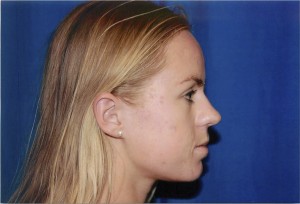 Profile View Before Rhinoplasty Surgery