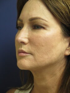 Female After to Face and Neck Lift Surgery