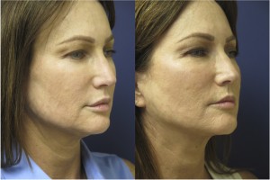 Face and Neck Lift Before and After