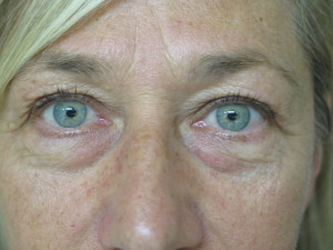 Eyes Close Up Before Blepharoplasty