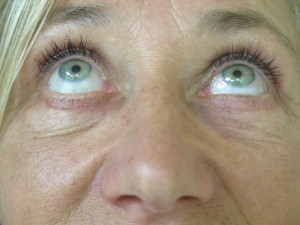 Female Eyes Up View After Blepharoplasty