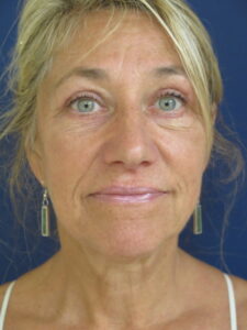 Front Photo of Eyes After Blepharoplasty