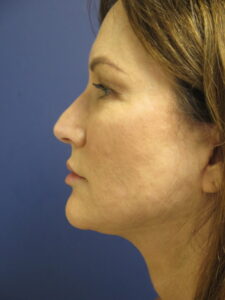 Side Profile Female After Face and Neck Lift Surgery