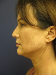 Side Profile Female Before Face and Neck Lift Surgery