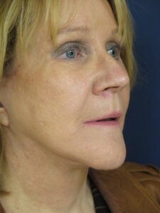 Female After Profile Face and Neck Lift Surgery