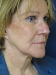 Female Before Profile Face and Neck Lift Surgery