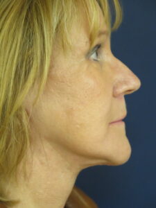 Female After Photo from Face and Neck Lift