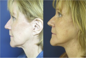 Before and After Photo of Face and Neck Lift