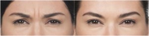 Botox Center Brow Before and After