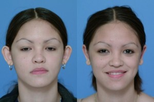 Otoplasty Surgery, Before and After Photo