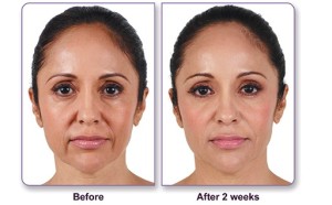 Before and After Dermal Filler Photos