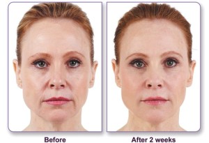Front View Dermal Filler Before and After