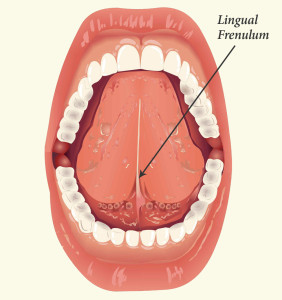 Tongue Tie