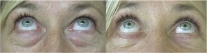 Upper and Lower Blepharoplasty Before and After Photo, Looking Up