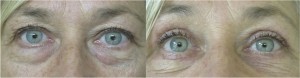 Blepharoplasty Before and After Photo