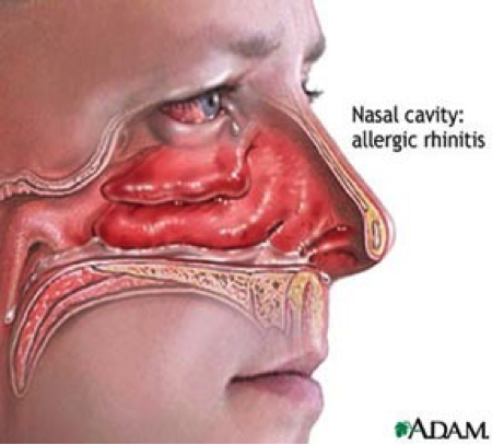 Allergic Rhinitis