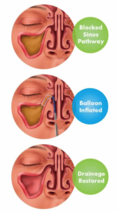 Balloon Sinuplasty