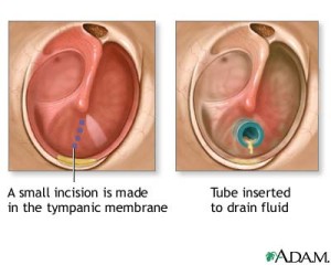 Ear Tubes