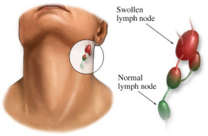 lymph node (Head and Neck Surgery)