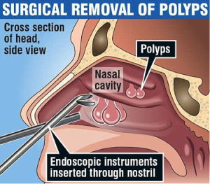 Nasal Polyp Surgical Removal