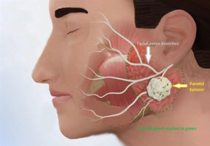 Look In at a Parotid Tumor