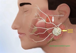 Inside View of Parotid Gland