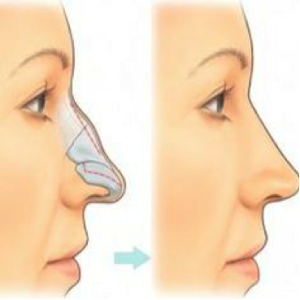 Rhinoplasty Graphic