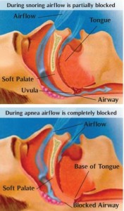 Snoring sleep apnea