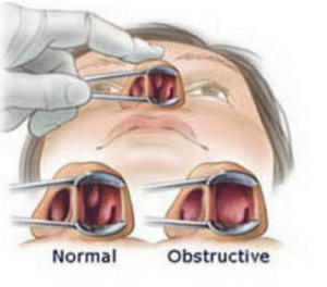 Turnbinate Reduction, See Normal versus Obstructive